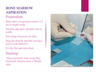 Preparation and staining
bone marrow aspiration
and biopsy
BONE MARROW
ASPIRATION
Preparation:
Make films of aspirated marrow 3-5
cm in length using:
Smooth edge glass spreader 2cm in
width.
Put a drop of marrow on slide.
Drag the drop by spreader leaving a
trail of cells behind it.
Fix the film and stain them.
Staining:
Most commonly done using May
Grunwald -Giemsa stain or Wright
stain.
 
