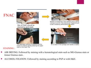 FNAC
STAINING :
 AIR DRYING: Followed by staining with a hematological stain such as MG-Giemsa stain or
Jenner Giemsa stain .
 ALCOHOL FIXATION: Followed by staining according to PAP or with H&E.
 