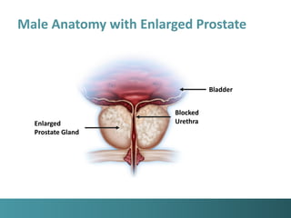 Patient education-presentation bph | PDF
