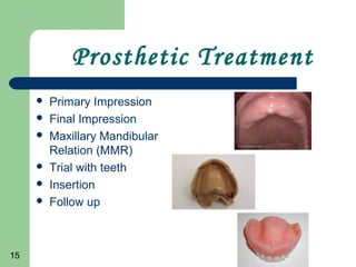 15
Prosthetic Treatment
Primary Impression
Final Impression
Maxillary Mandibular
Relation (MMR)
Trial with teeth
Insertion
Follow up