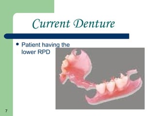 7
Current Denture
Patient having the
lower RPD