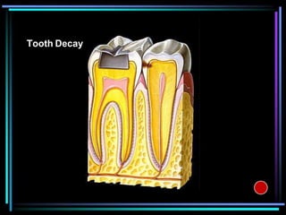 Debris Tooth Animation Dental Patient education Animations | PPSX