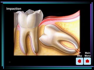 Simple Tooth Impaction Dental Patient education Animations | PPSX