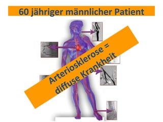 60 jähriger männlicher Patient Arteriosklerose = diffuse Krankheit 
