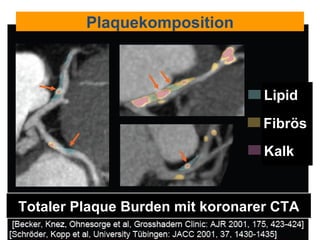 Lipid Fibrös Kalk Totaler Plaque Burden mit koronarer CTA Plaquekomposition 