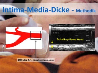 Intima-Media-Dicke -  Methodik IMD der Art. carotis communis Schallkopf-ferne Wand 