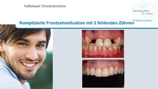 Fallbeispiel: Einzelzahnlücke Komplizierte Frontzahnsituation mit 2 fehlenden Zähnen 