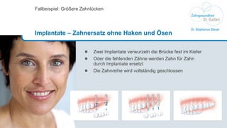 Zwei Implantate verwurzeln die Brücke fest im Kiefer Oder die fehlenden Zähne werden Zahn für Zahn  durch Implantate ersetzt  Die Zahnreihe wird vollständig geschlossen Fallbeispiel: Größere Zahnlücken Implantate – Zahnersatz ohne Haken und Ösen 