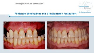 Fallbeispiel: Größere Zahnlücken Fehlende Seitenzähne mit 5 Implantaten restauriert 