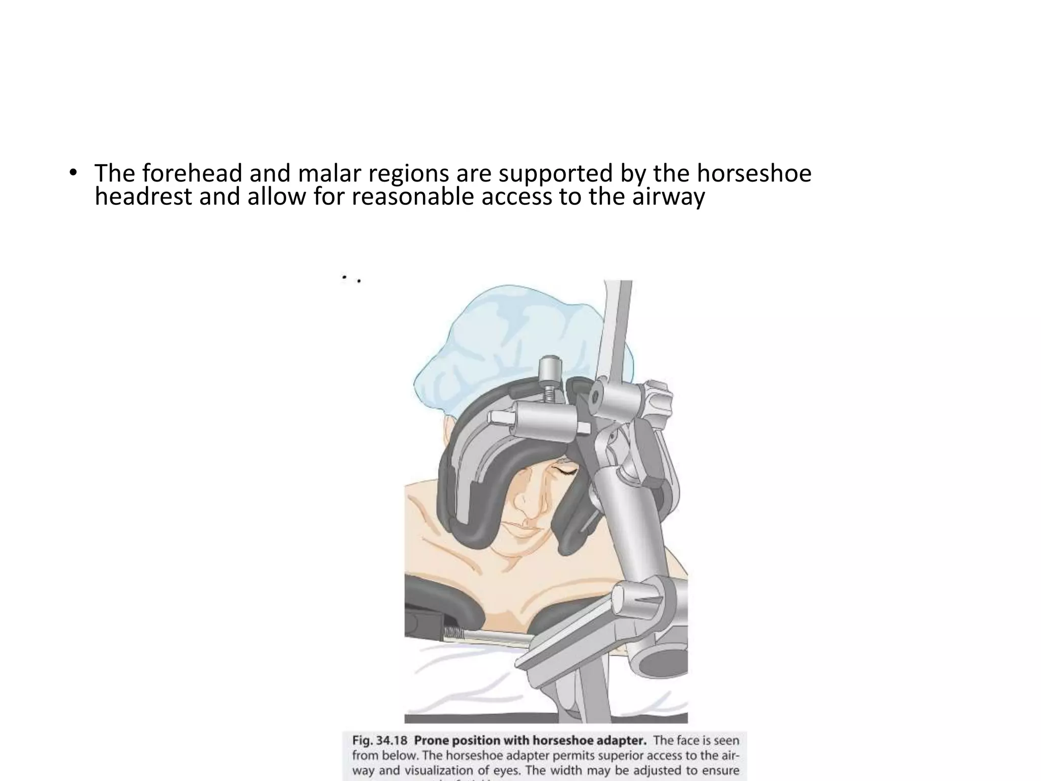 • The forehead and malar regions are supported by the horseshoe
headrest and allow for reasonable access to the airway
 