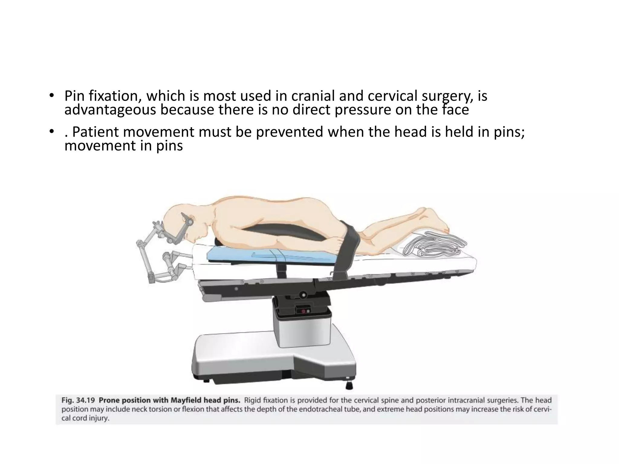 • Pin fixation, which is most used in cranial and cervical surgery, is
advantageous because there is no direct pressure on the face
• . Patient movement must be prevented when the head is held in pins;
movement in pins
 