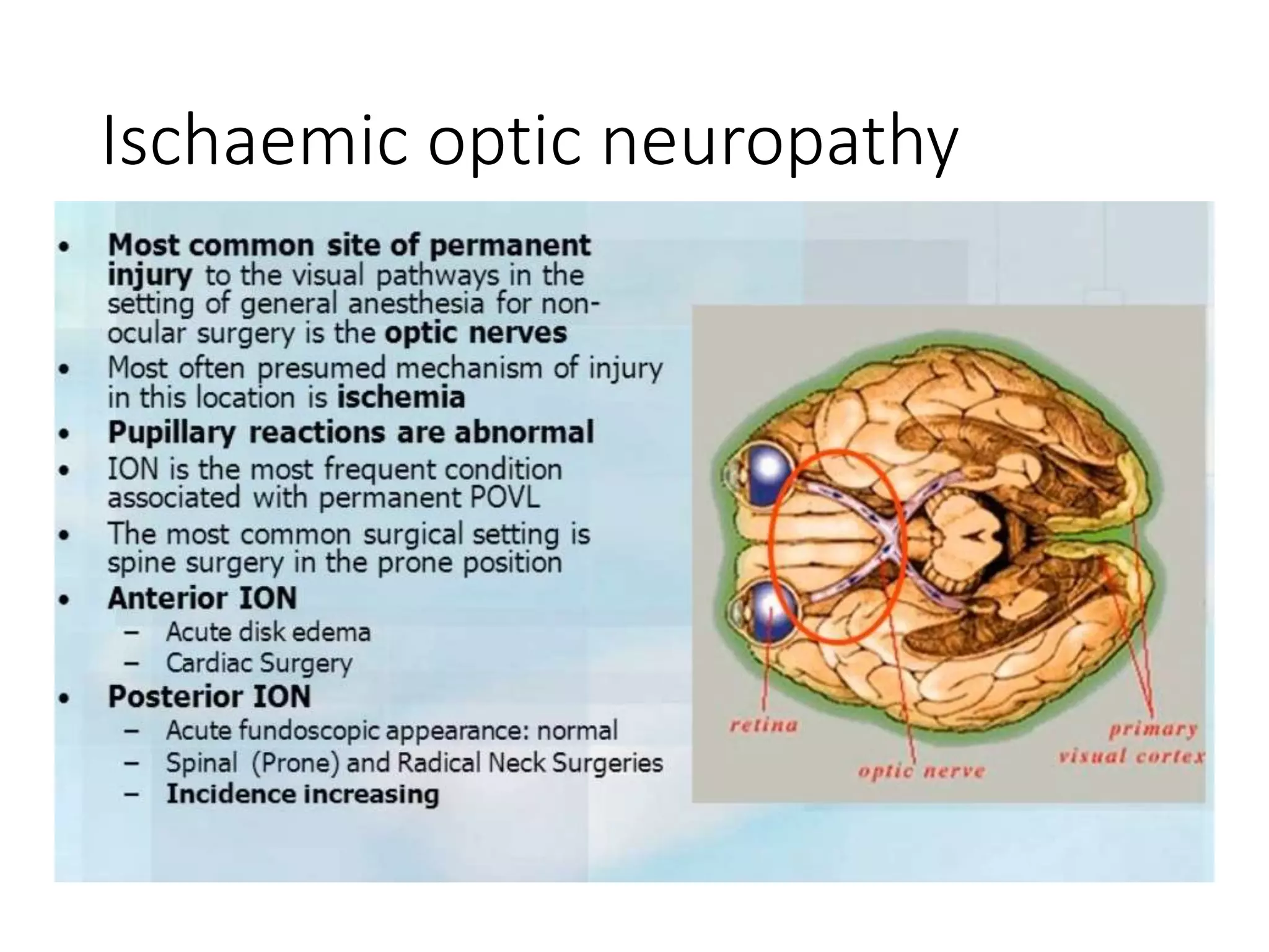 Ischaemic optic neuropathy
 