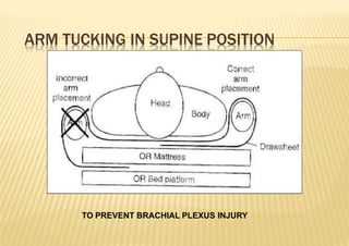 ARM TUCKING IN SUPINE POSITION
TO PREVENT BRACHIAL PLEXUS INJURY
 