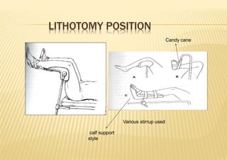LITHOTOMY POSITION
Various stirrup used
calf support
style
Candy cane
 