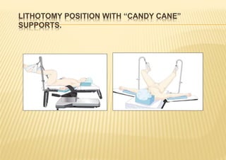 LITHOTOMY POSITION WITH “CANDY CANE”
SUPPORTS.
 