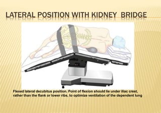 Flexed lateral decubitus position. Point of flexion should lie under iliac crest,
rather than the flank or lower ribs, to optimize ventilation of the dependent lung
LATERAL POSITION WITH KIDNEY BRIDGE
 