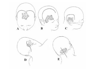 Synchronous Position Surgery Patient Positioning.ppt in neurosurgery operations in theatre | PPT