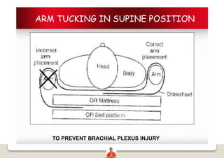 ARM TUCKING IN SUPINE POSITION
TO PREVENT BRACHIAL PLEXUS INJURY
 