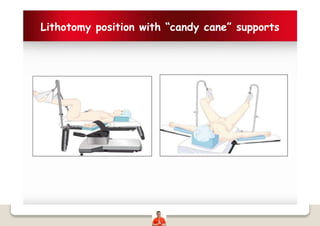 Lithotomy position with “candy cane” supports
 