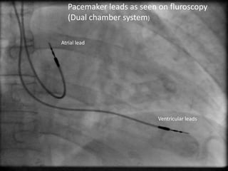 Patients with pacemaker anaesthetic implications | PPTX