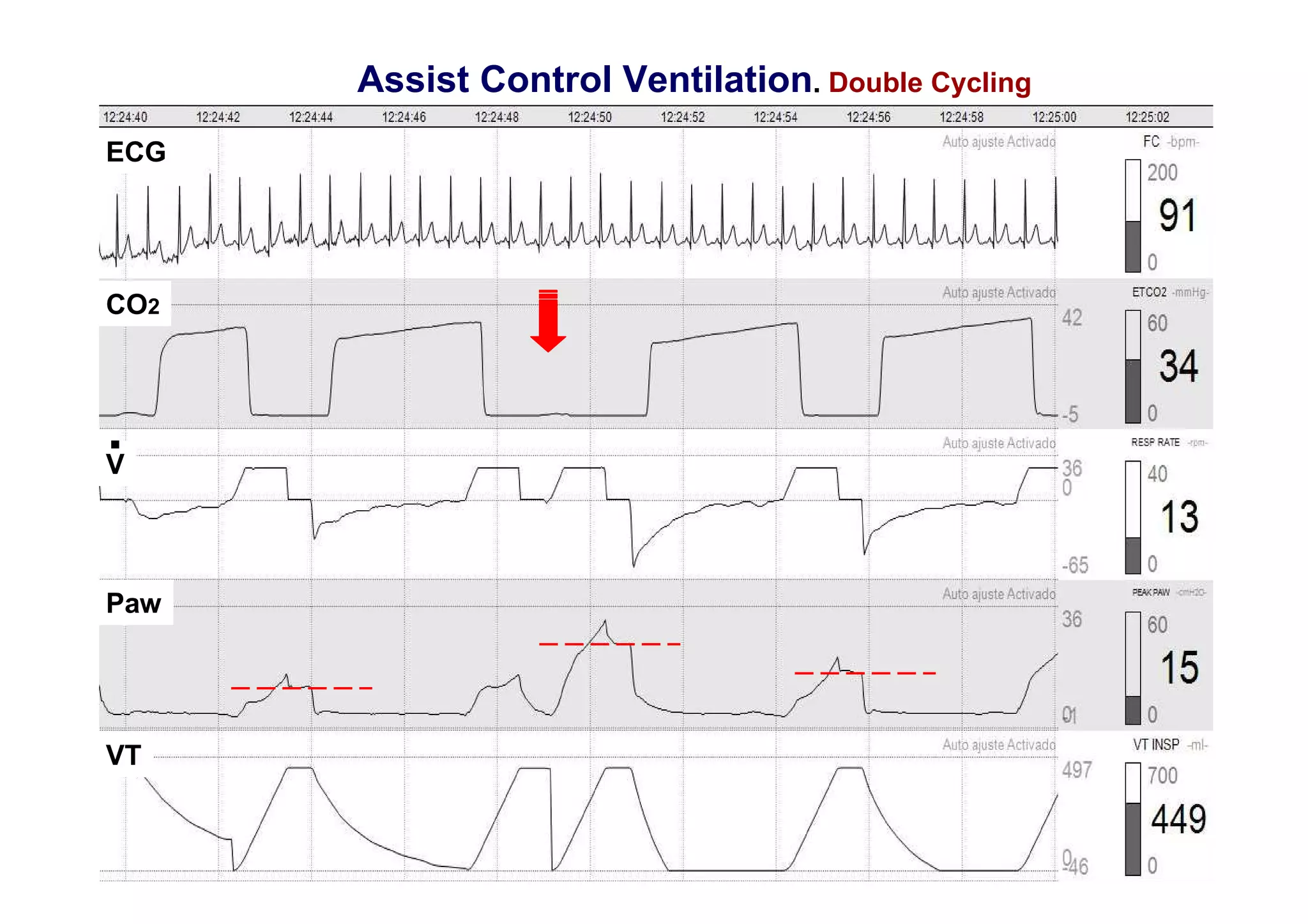 Patient ventilator interactions during mechanical ventilation | PDF