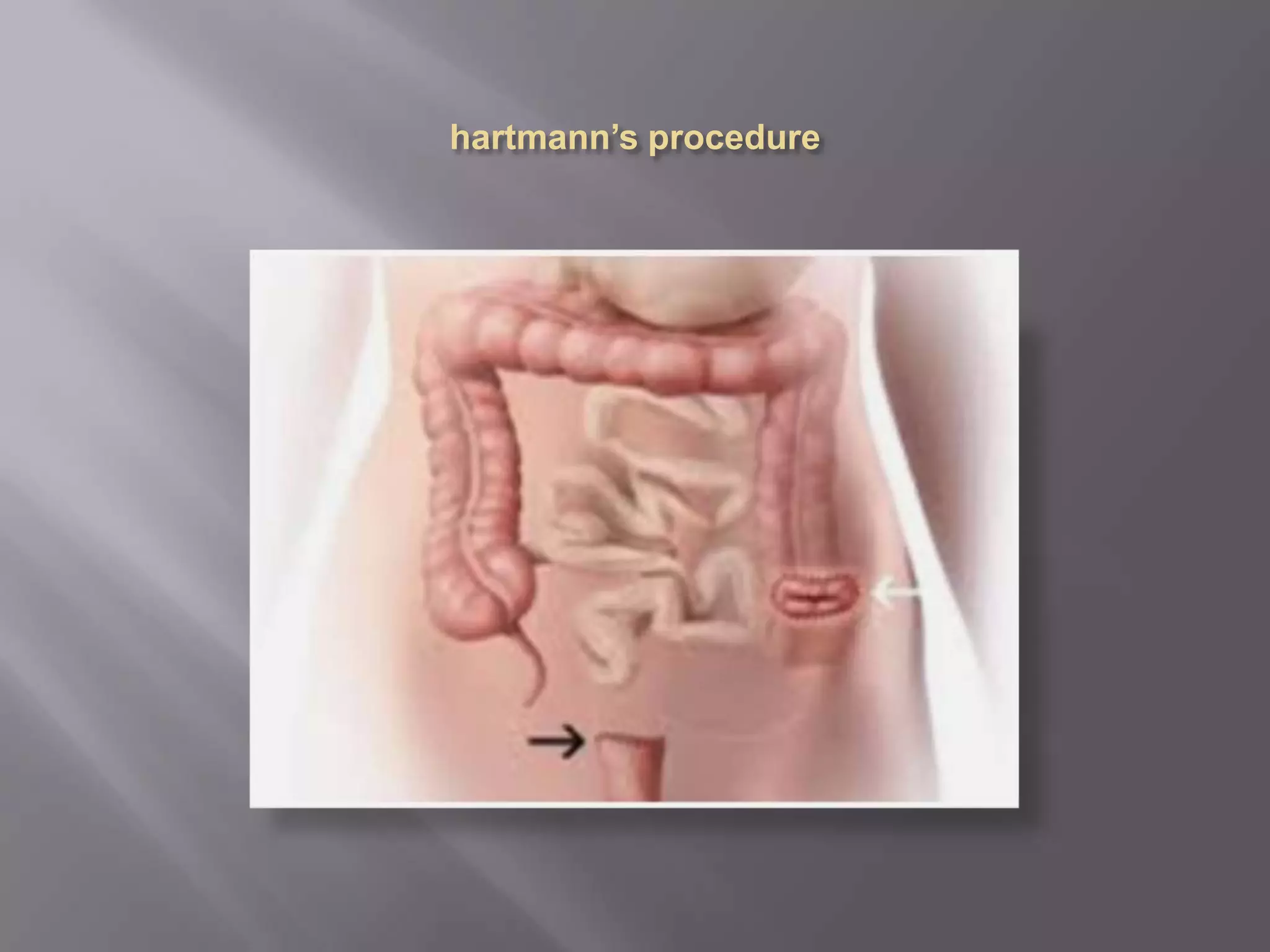 Patient with chronic constipation & abdominal distension | PPTX