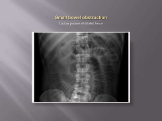 Ladder pattern of dilated loops
 