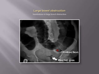 haustrations in large bowel obstruction
 
