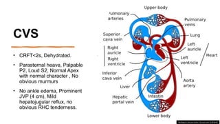 Palpable P2 Chronic Thromboembolic pulmonary arterial hypertension (CTEPH) | PPTX