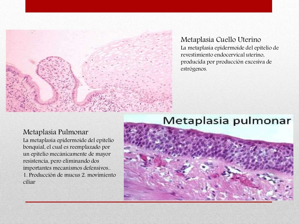 metaplasia