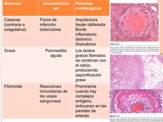 Necrosis

Caseosa
(contraria a
coagulativa)

Grasa

Fibrinoide

Característica
en
Focos de
infección
tuberculosa

Patrones
morfológicos
Arquitectura
tisular obliterada
Borde
inflamatorio
distintivo:
Granuloma

Pancreatitis
aguda

Los ácidos
grasos liberados
se combinan con
el calcio,
produciendo
saponificación
grasa

Reacciones
inmunitarias de
los vasos
sanguíneos

Prominente
cuando hay
complejos
antígeno,
anticuerpo en las
paredes de
arterias

 