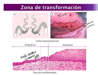 Presentación zona de transformación-Patología II | PDF