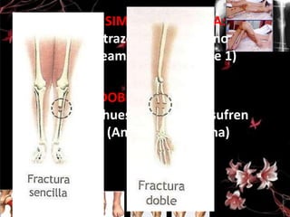 FRACTURAS SIMPLE O SENCILLA:
Presenta un trazo y los huesos no
pierden alineamiento (se rompe 1)
FRACTURA DOBLE:
Cuando dos huesos continuos sufren
una ruptura. (Antebrazo y pierna)

 