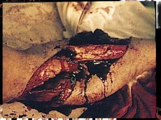 FRACTURA ABIERTA O EXPUESTA:
Los huesos tienen aristas cortantes,
provocan que la piel, los músculos
y tejidos se rompan.
FRACTURA CERRADA:
Los fragmentos no afectan el tejido blando que
lo cubre

 