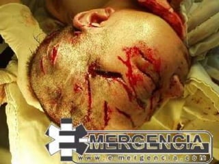 FRACTURA EN RAMA VERDE:
El hueso no se rompe en su totalidad
su ruptura es parcial (1 lado)
FRACTURA CONMINUTA:
(Fragmentaria) El hueso se rompe en
múltiples fragmentos.
FRACTURA COMPLICADA:
Son las que se insertan en otras
estructuras como nervios y ponen el
riesgo la vida (cráneo)

 