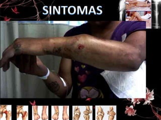 • Dolor intenso
• Deformidad de la región
• Hematomas o enrojecimiento de la zona
afectada.
• Incapacidad de movimiento.
• Hinchazón

 