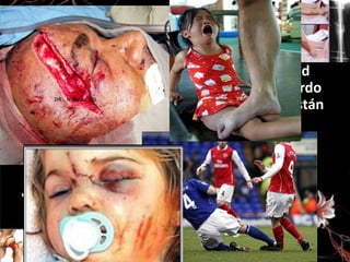 • Las fracturas son la pérdida de continuidad
ósea o cartilaginosa, se clasifican de acuerdo
a la dirección y descripción entre estas están
las dobles, sencillas, abierta, cerrada,
completa, incompleta etc.
• Las causas llegan a ser por enfermedad,
caída, maltrato, sobrepeso y accidentes.
• Sus síntomas son dolor, deformidad,
incapacidad funcional, movilidad.

 