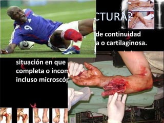• Una fractura es la pérdida de continuidad
normal de la sustancia ósea o cartilaginosa.
• Abarca todas las roturas óseas, desde la
situación en que el hueso se rompe, ya sea
completa o incompleta, fragmentada e
incluso microscópica.

 