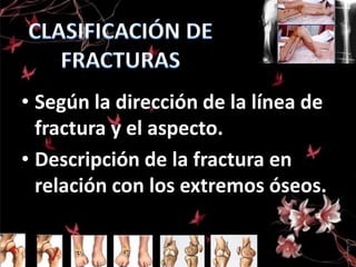 • Según la dirección de la línea de
fractura y el aspecto.
• Descripción de la fractura en
relación con los extremos óseos.

 