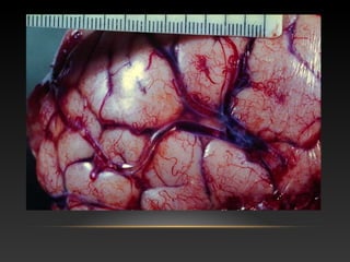 vasculopatias cerebrales