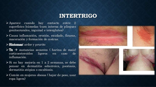 Quien se ha librado de la eccema en las manos