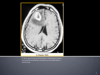 XANTOASTROCITOMA PLEOMÓRFICO 