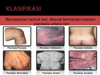 Berdasarkan bentuk lesi, dikenal bermacam-macam
psoriasis antara lain:
Psoriasis Puncata Psoriasis Folikularis Psoriasis Guttata
Psoriasis Numularis Psoriasis Girata Psoriasis Anularis
 