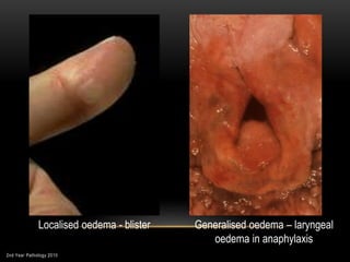 2nd Year Pathology 2010
Localised oedema - blister Generalised oedema – laryngeal
oedema in anaphylaxis
 