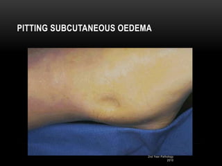 2nd Year Pathology
2010
PITTING SUBCUTANEOUS OEDEMA
 