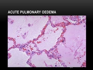 2nd Year Pathology
2010
ACUTE PULMONARY OEDEMA
 