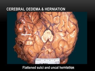 2nd Year Pathology
2010
CEREBRAL OEDEMA & HERNIATION
Flattened sulci and uncal herniation
 