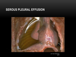 2nd Year Pathology
2010
SEROUS PLEURAL EFFUSION
 