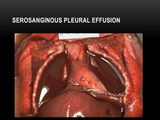2nd Year Pathology
2010
SEROSANGINOUS PLEURAL EFFUSION
 