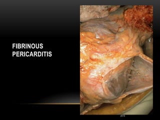 2nd Year Pathology
2010
FIBRINOUS
PERICARDITIS
 